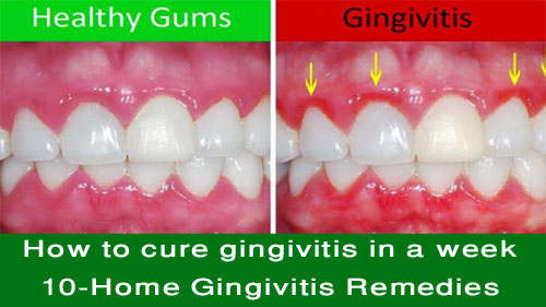 How to cure gingivitis in a week