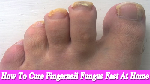 How To Cure Fingernail Fungus Fast At Home