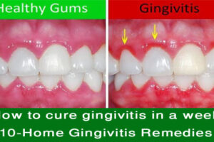 How to cure gingivitis in a week