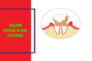 Gum Disease Gone Review